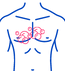 Mediastinal Mass