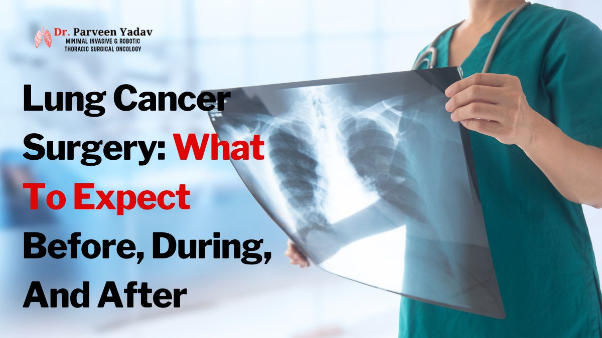 Lung Cancer Surgery: What To Expect Before, During, And After