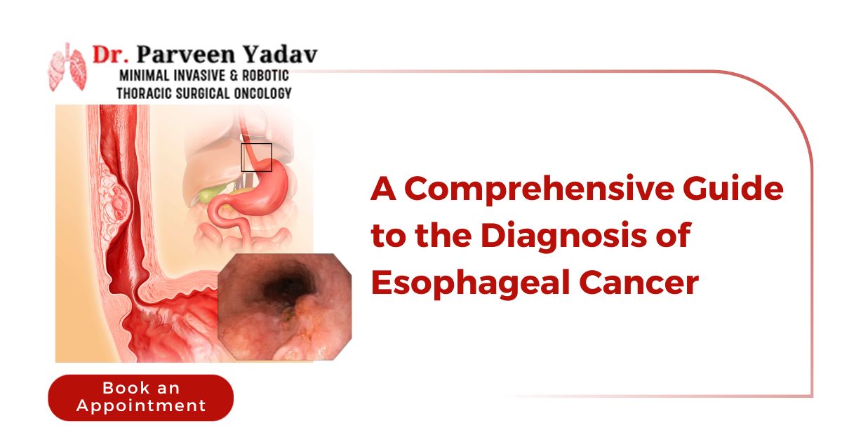 A Comprehensive Guide to the Diagnosis of Esophageal Cancer