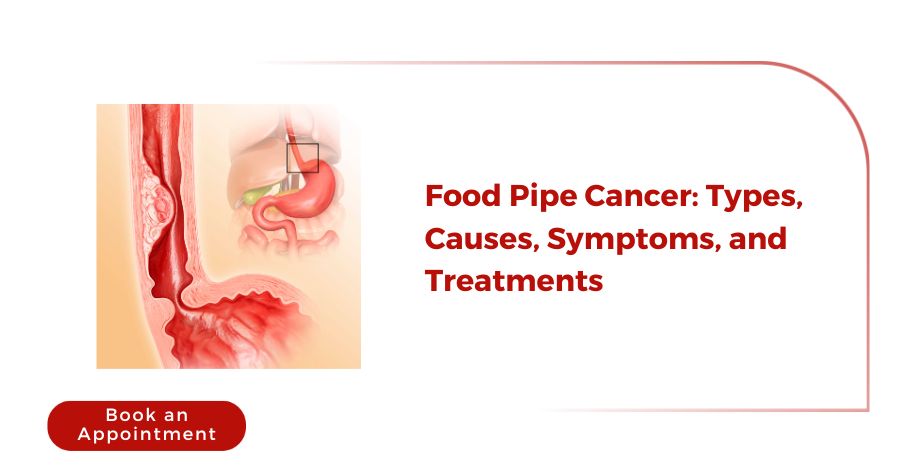 Food Pipe Cancer: Types, Causes, Symptoms, and Treatments