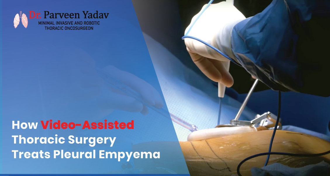 How Video-Assisted Thoracic Surgery Treats Pleural Empyema