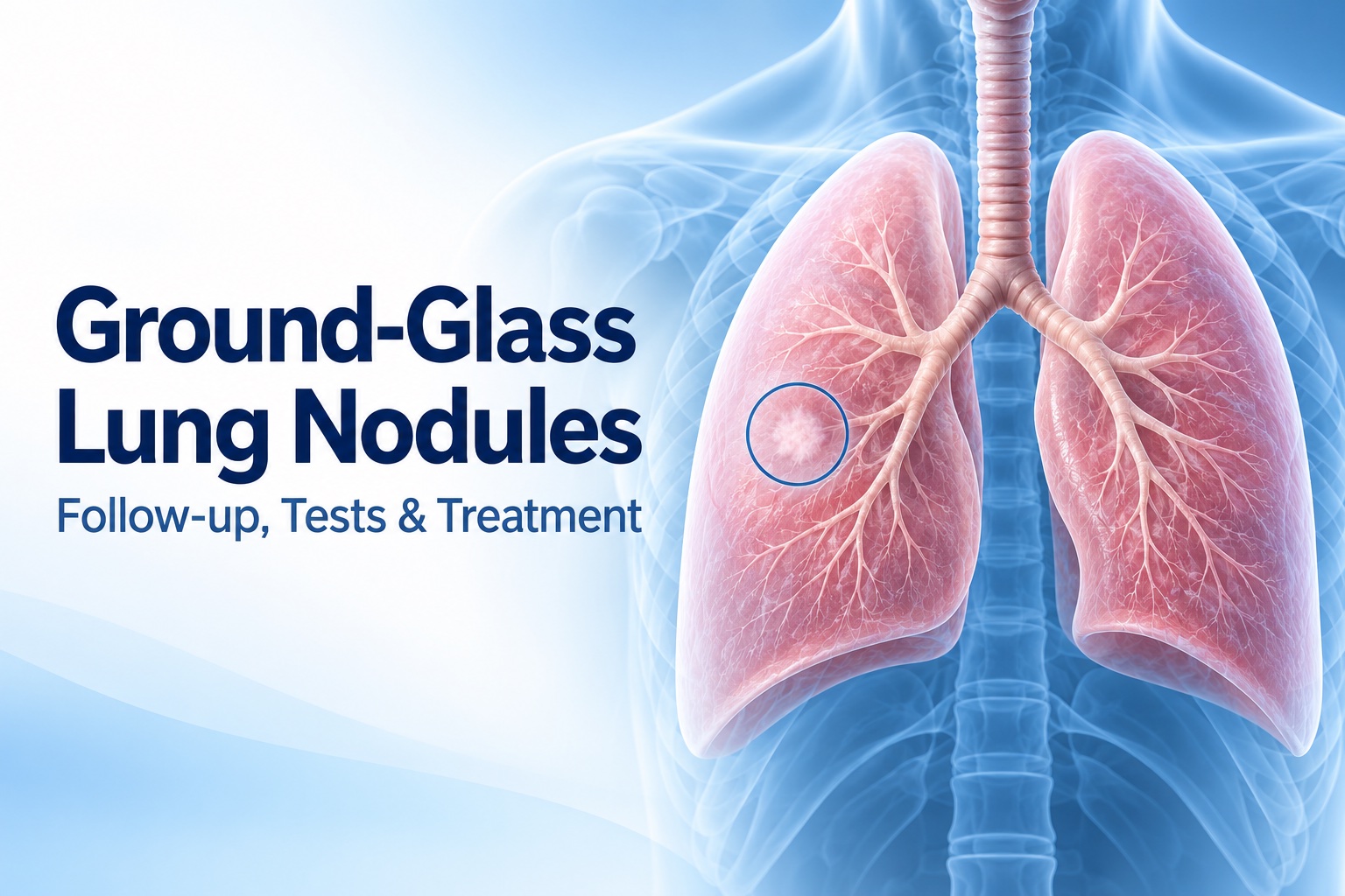 Ground-Glass Lung Nodules: Follow-Up, Cancer Risk and When Surgery Is Needed