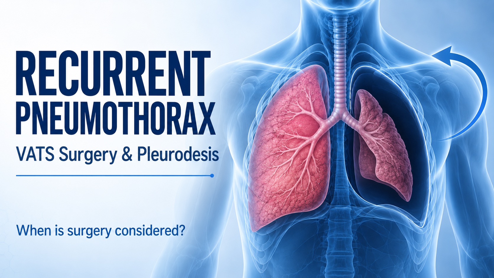 Recurrent Pneumothorax: When Are VATS and Pleurodesis Needed?