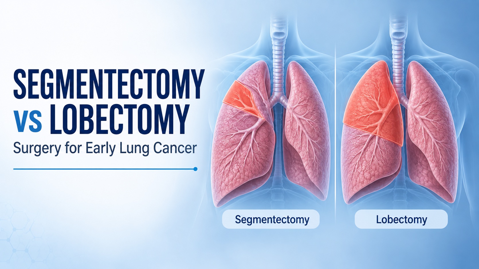 Segmentectomy vs Lobectomy: Choosing Surgery for Early Lung Cancer